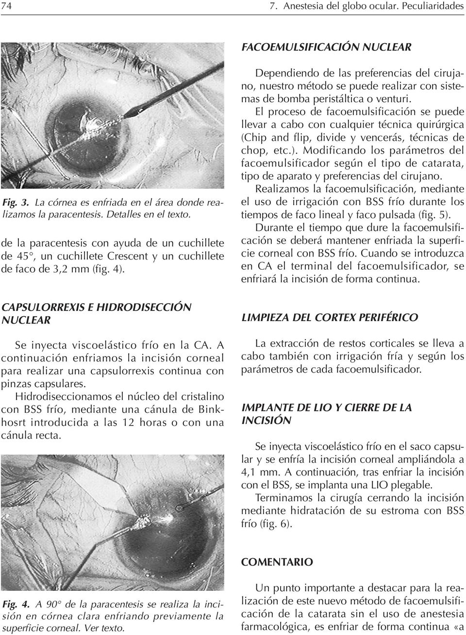 A continuación enfriamos la incisión corneal para realizar una capsulorrexis continua con pinzas capsulares.