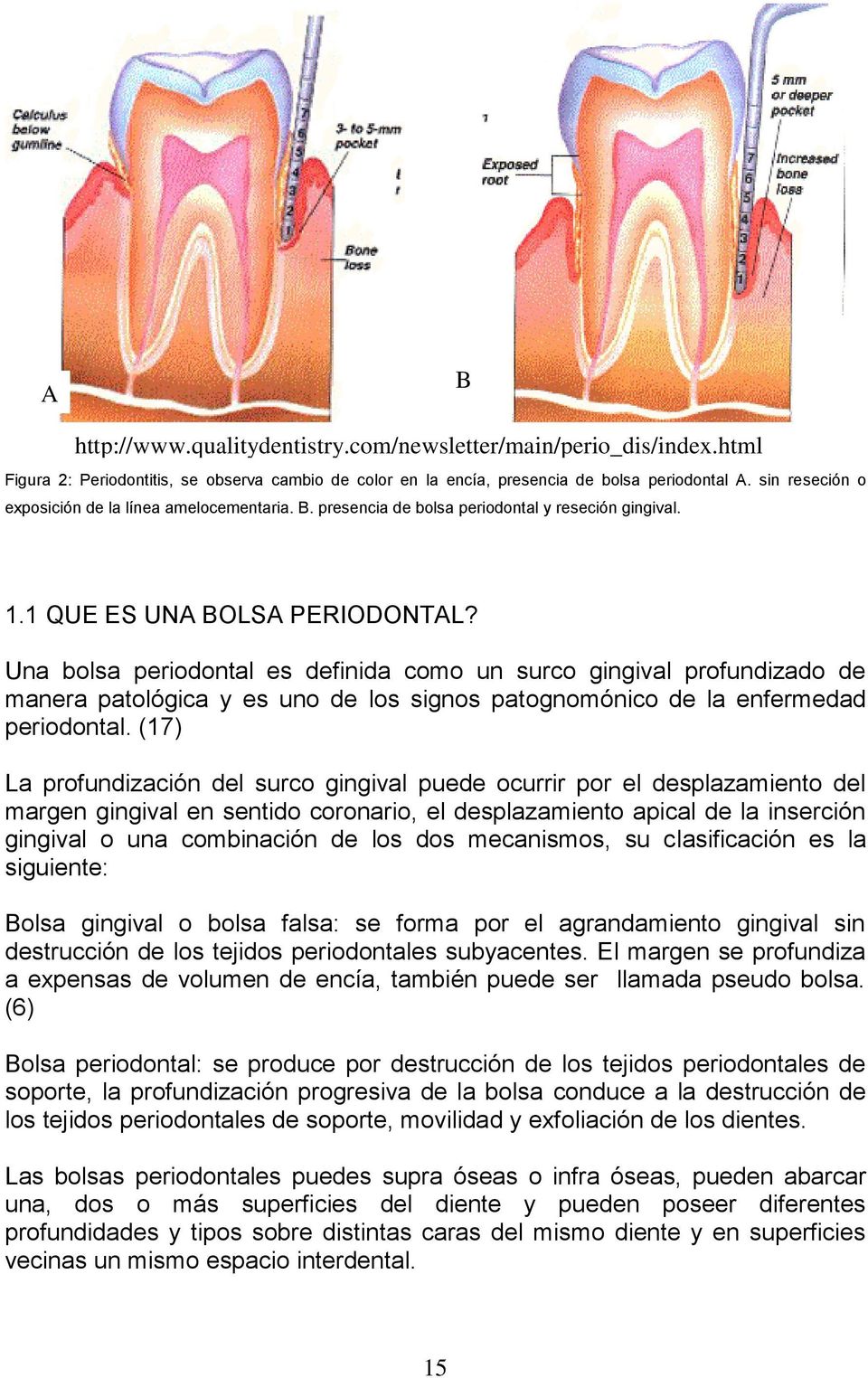 Una bolsa periodontal es definida como un surco gingival profundizado de manera patológica y es uno de los signos patognomónico de la enfermedad periodontal.