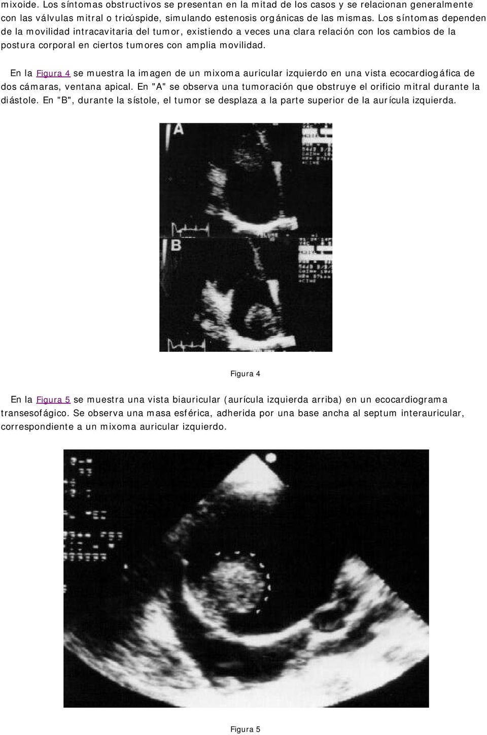 En la Figura 4 se muestra la imagen de un mixoma auricular izquierdo en una vista ecocardiogáfica de dos cámaras, ventana apical.