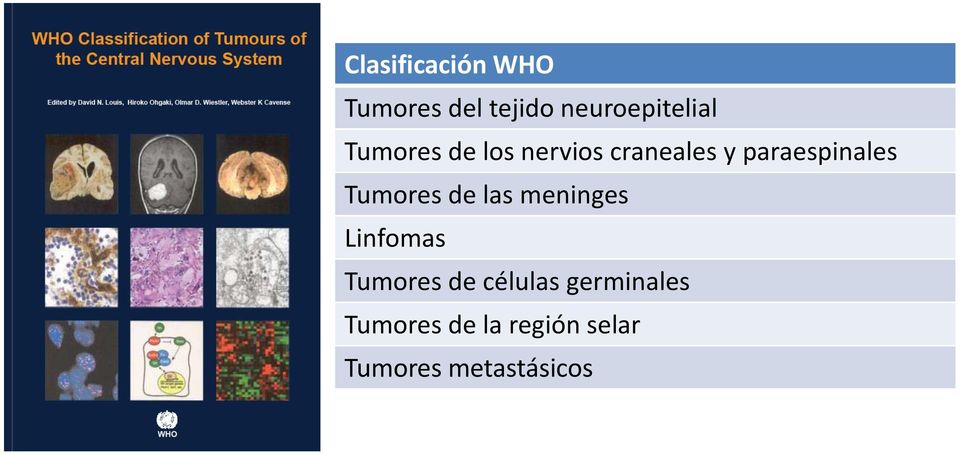 Tumores de las meninges Linfomas Tumores de células