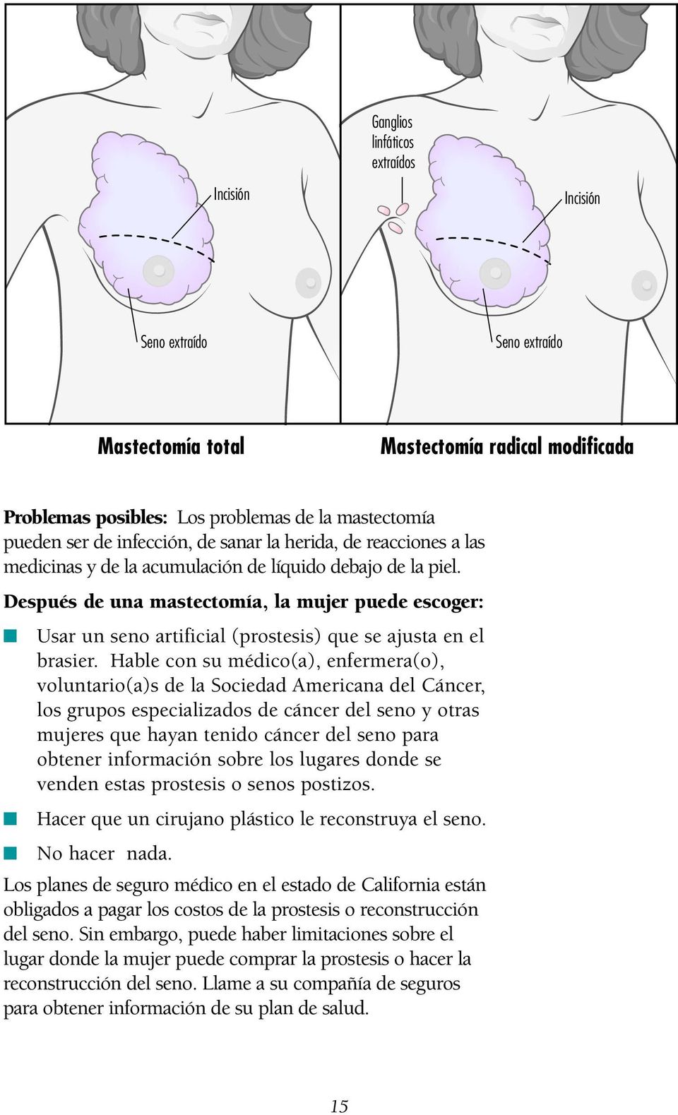 Después de una mastectomía, la mujer puede escoger: Usar un seno artificial (prostesis) que se ajusta en el brasier.