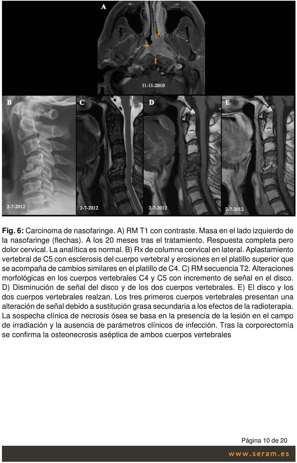 Aplastamiento vertebral de C5 con esclerosis del cuerpo vertebral y erosiones en el platillo superior que se acompaña de cambios similares en el platillo de C4. C) RM secuencia T2.