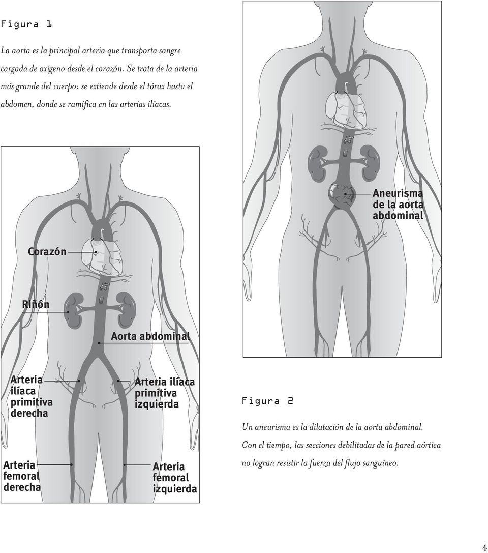 Aneurisma de la aorta abdominal Corazón Riñón Aorta abdominal Arteria ilíaca primitiva derecha Arteria femoral derecha Arteria ilíaca primitiva