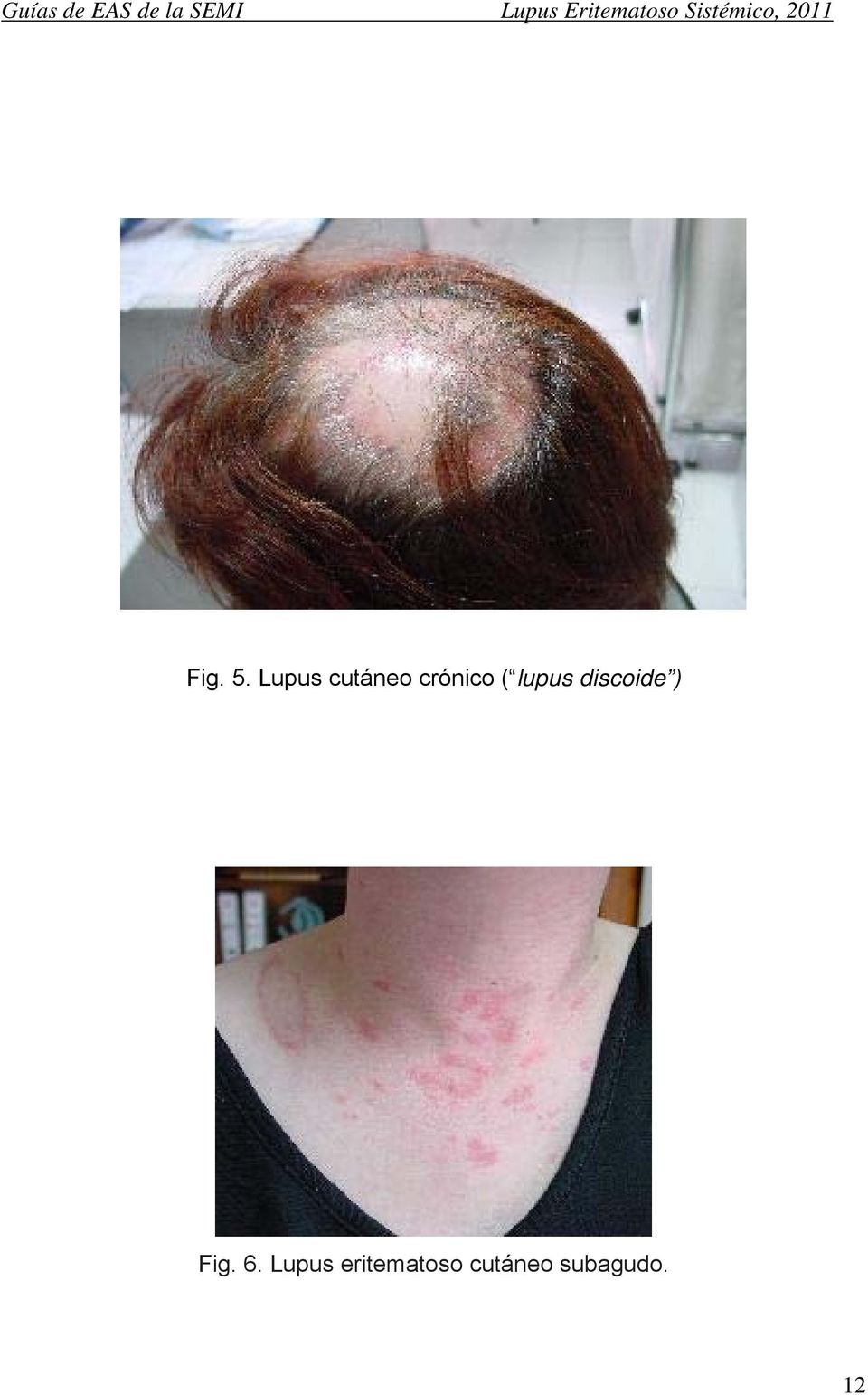 lupus discoide ) Fig. 6.