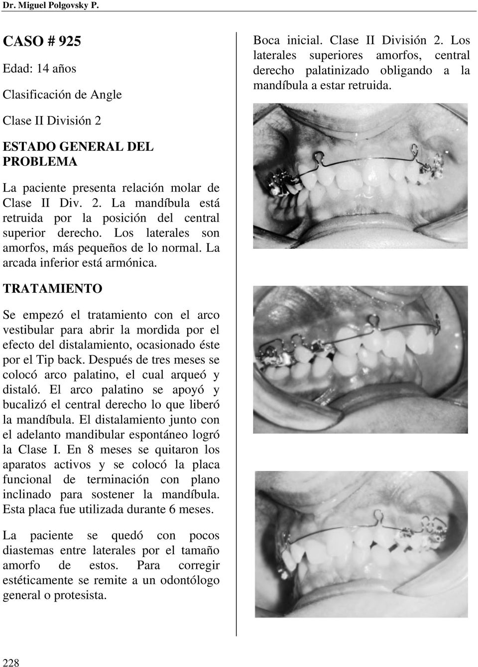 Clase II División 2 ESTADO GENERAL DEL PROBLEMA La paciente presenta relación molar de Clase II Div. 2. La mandíbula está retruida por la posición del central superior derecho.