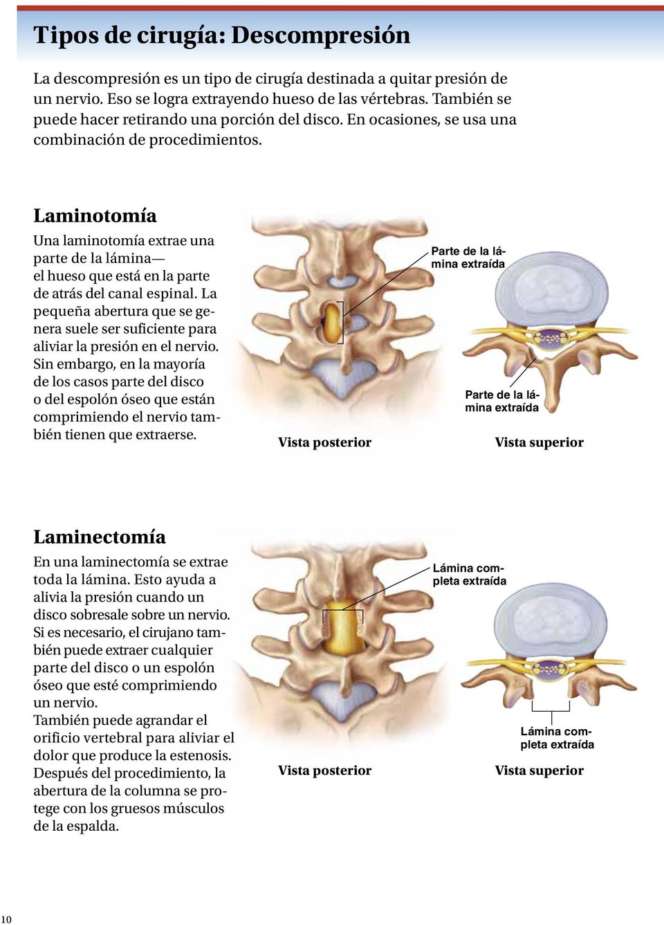 Laminotomía Una laminotomía extrae una parte de la lámina el hueso que está en la parte de atrás del canal espinal.