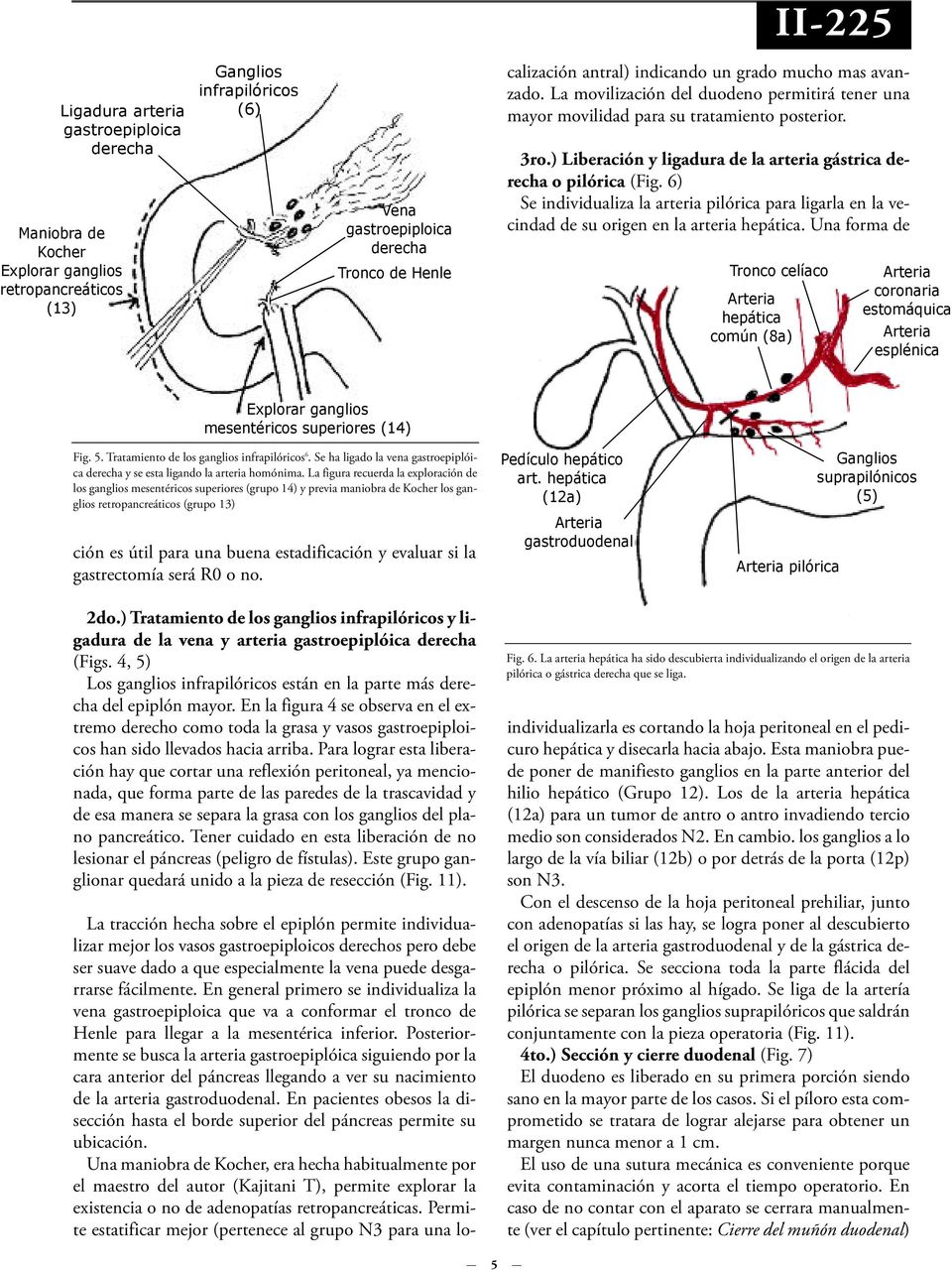 ) Liberación y ligadura de la arteria gástrica derecha o pilórica (Fig. 6) Se individualiza la arteria pilórica para ligarla en la vecindad de su origen en la arteria hepática.