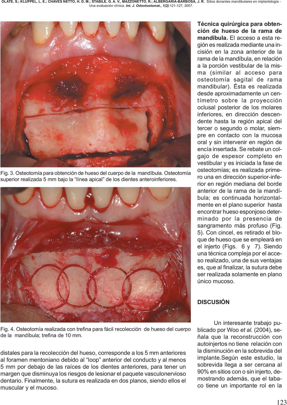 El acceso a esta región es realizada mediante una incisión en la zona anterior de la rama de la mandíbula, en relación a la porción vestibular de la misma (similar al acceso para osteotomía sagital