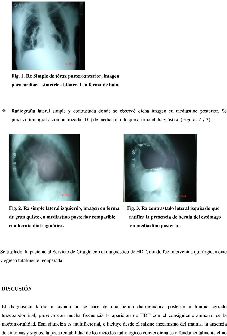 y 3). Fig. 2. Rx simple lateral izquierdo, imagen en forma de gran quiste en mediastino posterior compatible con hernia diafragmática. Fig. 3. Rx contrastado lateral izquierdo que ratifica la presencia de hernia del estómago en mediastino posterior.