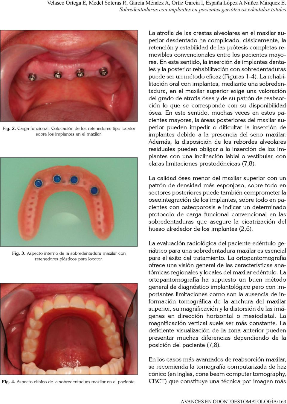 La atrofia de las crestas alveolares en el maxilar superior desdentado ha complicado, clásicamente, la retención y estabilidad de las prótesis completas removibles convencionales entre los pacientes
