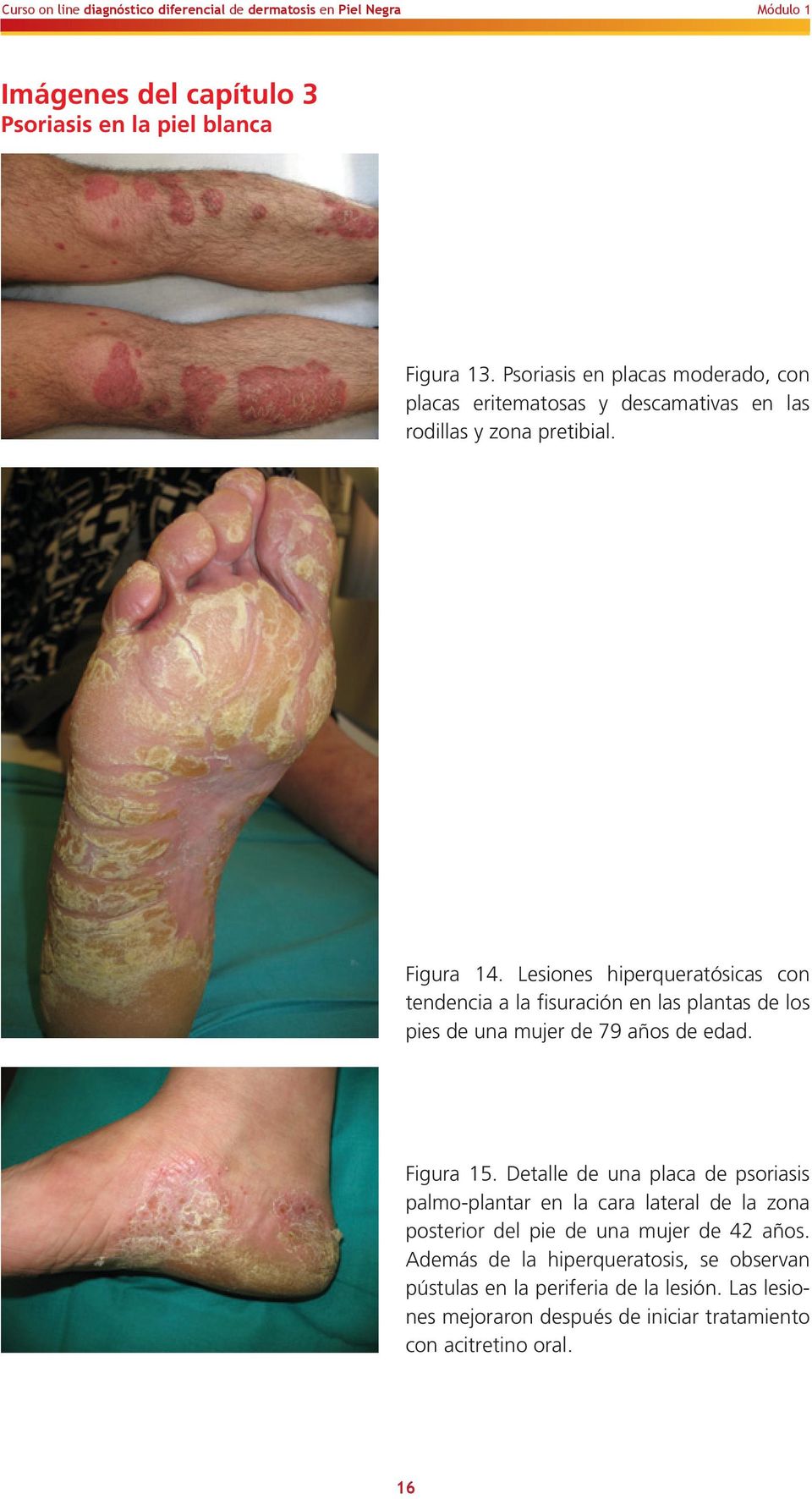 Lesiones hiperqueratósicas con tendencia a la fisuración en las plantas de los pies de una mujer de 79 años de edad. Figura 15.