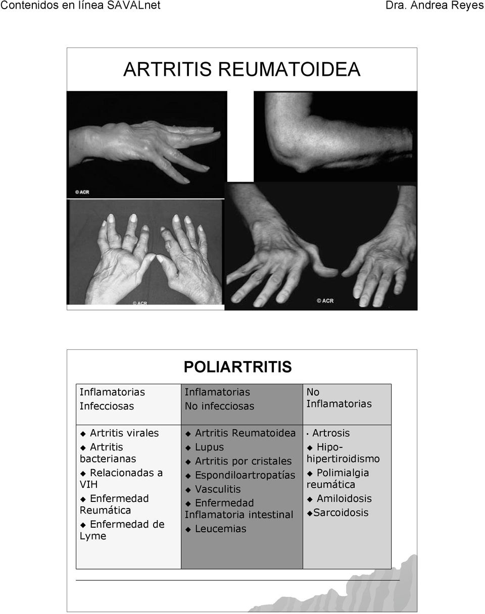 Enfermedad de Lyme! Artritis Reumatoidea! Lupus! Artritis por cristales! Espondiloartropatías!