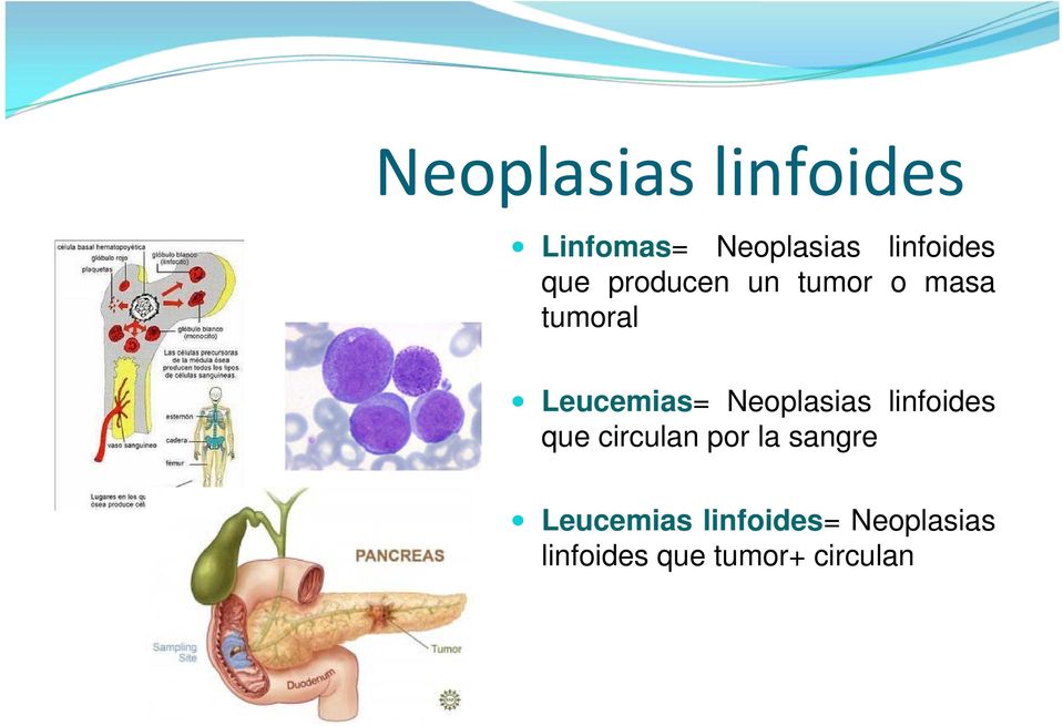 Neoplasias linfoides que circulan por la sangre