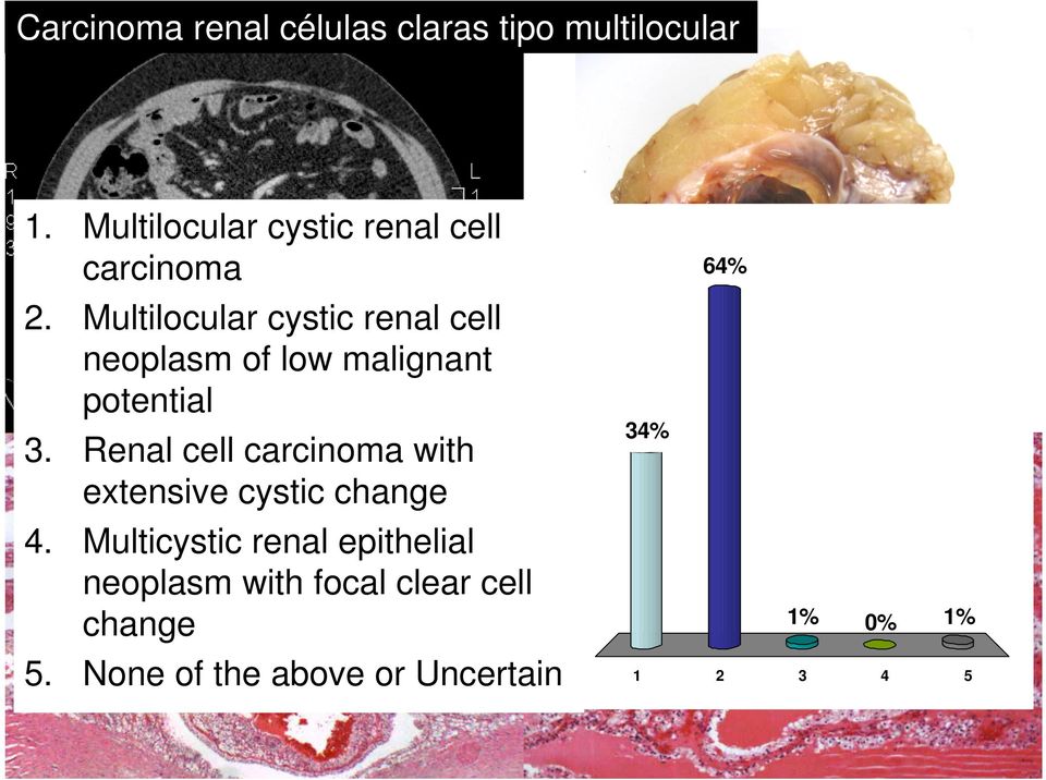 Multilocular cystic renal cell neoplasm of low malignant potential 3.