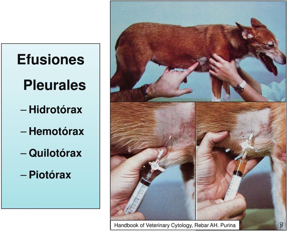 Quilotórax Piotórax