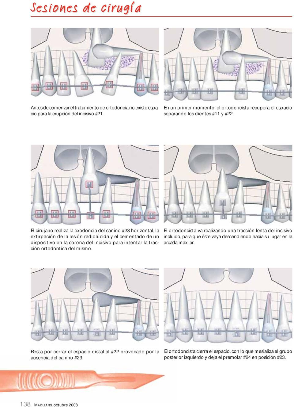 ortodóntica del mismo. El ortodoncista va realizando una tracción lenta del incisivo incluido, para que éste vaya descendiendo hacia su lugar en la arcada maxilar.