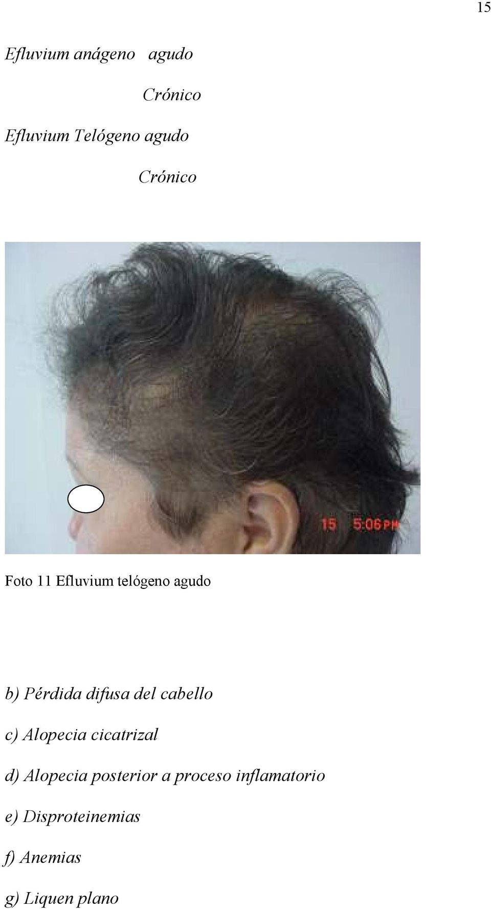 del cabello c) Alopecia cicatrizal d) Alopecia posterior a