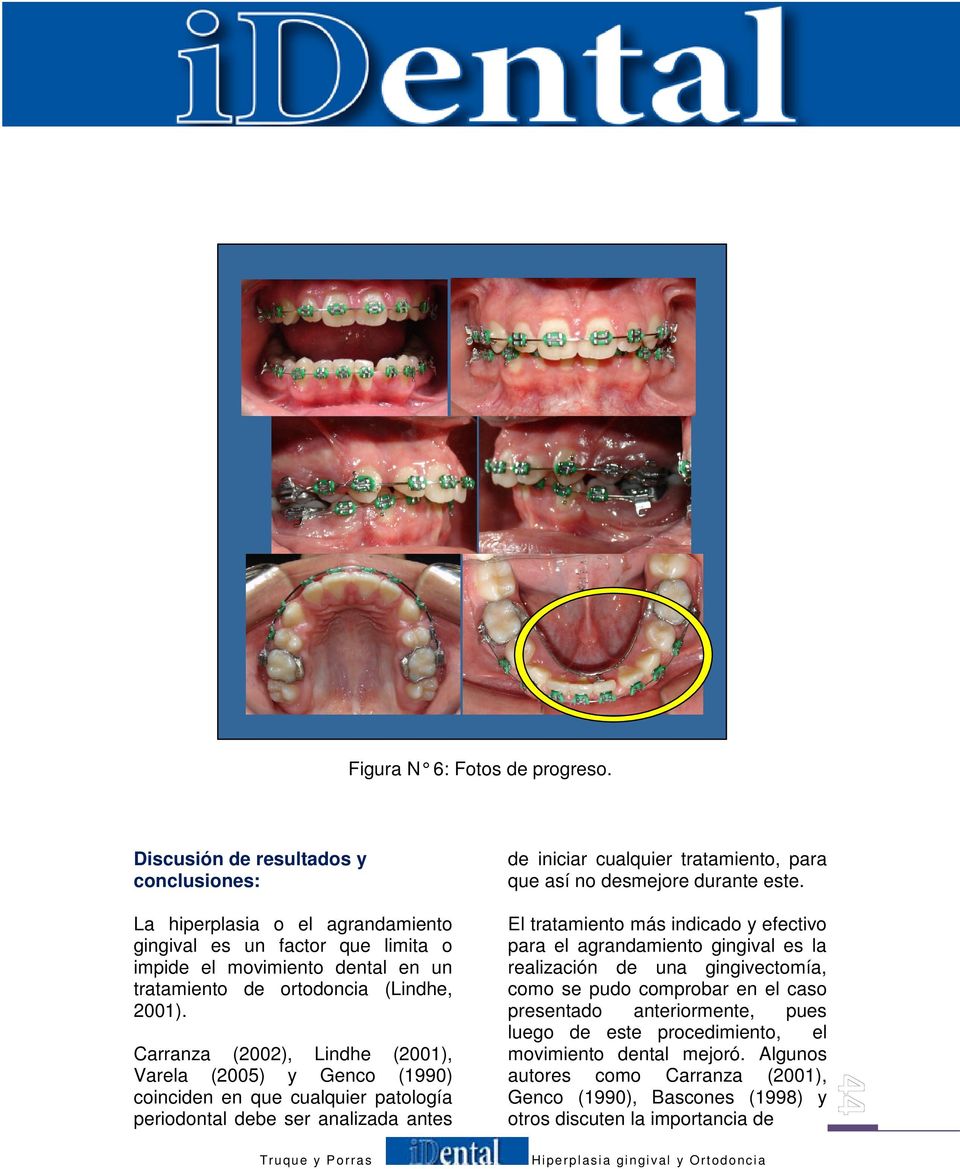 Carranza (2002), Lindhe (2001), Varela (2005) y Genco (1990) coinciden en que cualquier patología periodontal debe ser analizada antes de iniciar cualquier tratamiento, para que así no