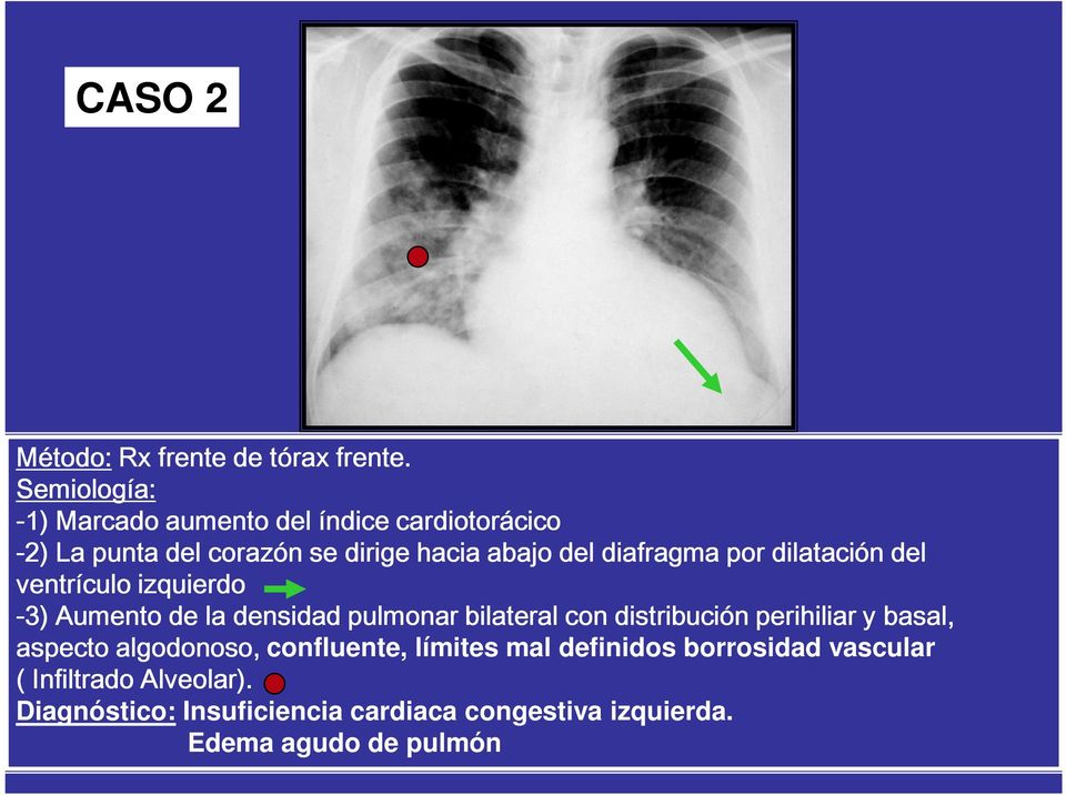 diafragma por dilatación del ventrículo izquierdo -3) Aumento de la densidad pulmonar bilateral con distribución