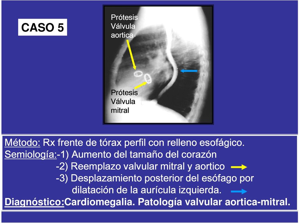 Semiología:-1) Aumento del tamaño del corazón -2) Reemplazo valvular mitral y aortico