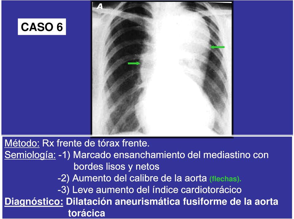 lisos y netos -2) Aumento del calibre de la aorta (flechas).