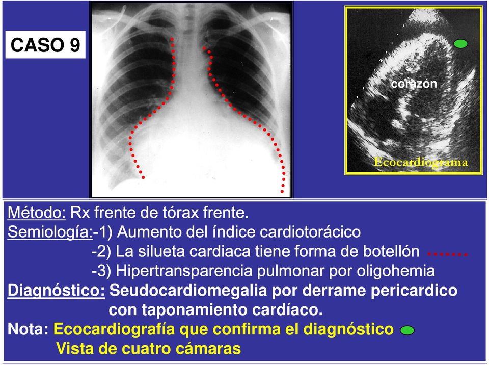 botellón -3) Hipertransparencia pulmonar por oligohemia Diagnóstico: Seudocardiomegalia por