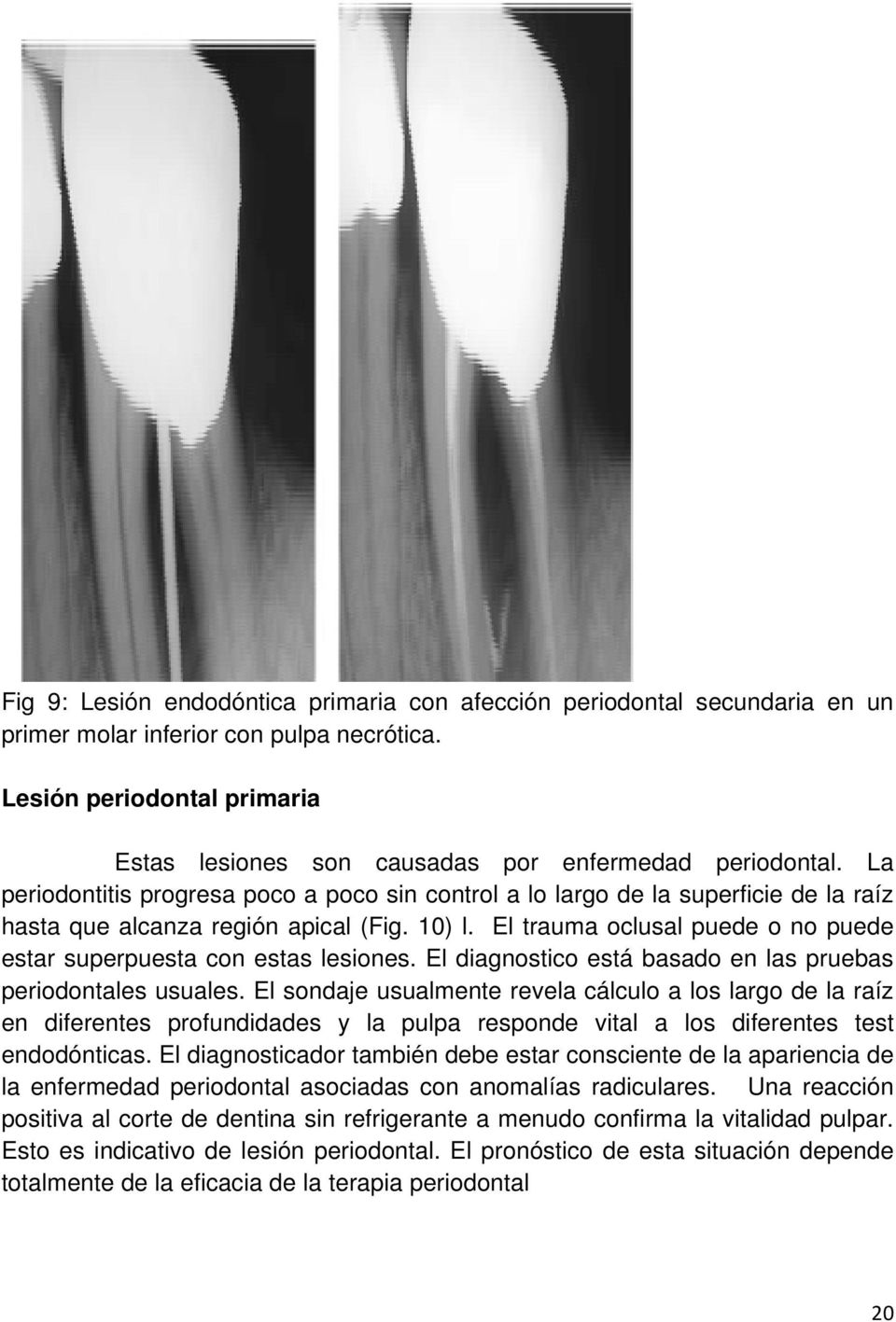 La periodontitis progresa poco a poco sin control a lo largo de la superficie de la raíz hasta que alcanza región apical (Fig. 10) l.