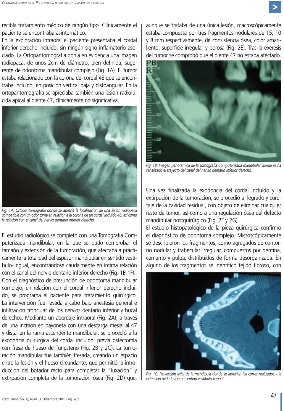 La Ortopantomografía ponía en evidencia una imagen radiopaca, de unos 2cm de diámetro, bien definida, sugerente de odontoma mandibular complejo (Fig. 1A).