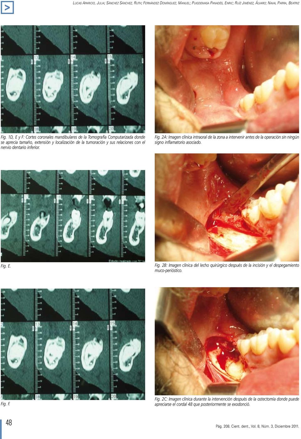 2A: Imagen clínica intraoral de la zona a intervenir antes de la operación sin ningún signo inflamatorio asociado. Fig.