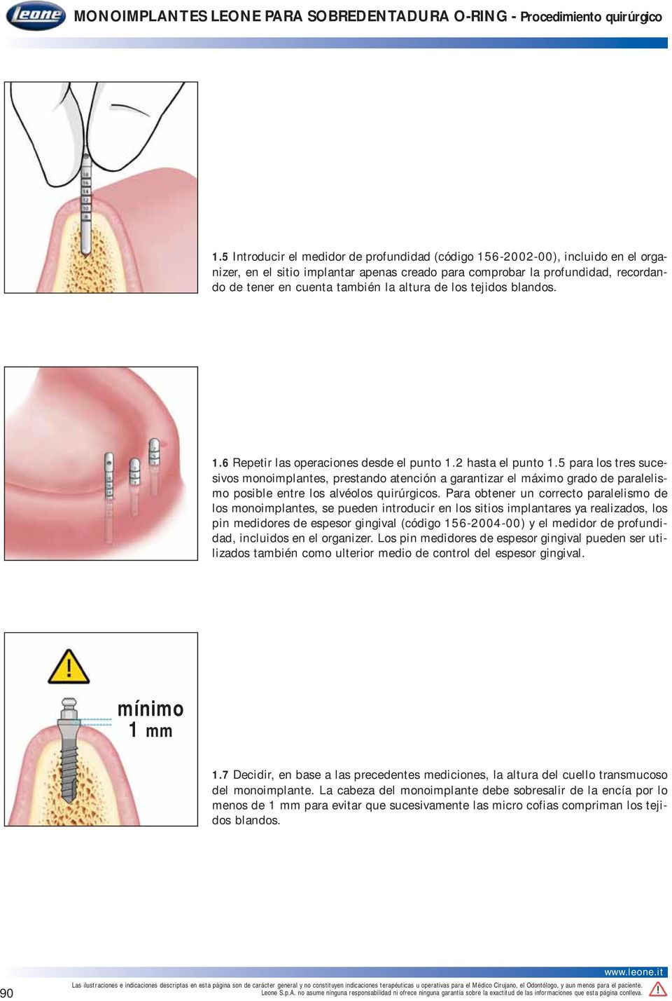5 para los tres sucesivos monoimplantes, prestando atención a garantizar el máximo grado de paralelismo posible entre los alvéolos quirúrgicos.