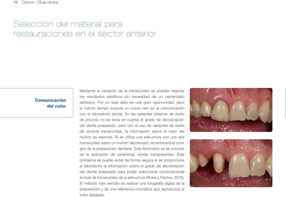 En las variantes clásicas de óxido de zirconio no se tenía en cuenta el grado de decoloración del diente preparado, pero con el uso de variantes de óxido de zirconio translúcidas, la información