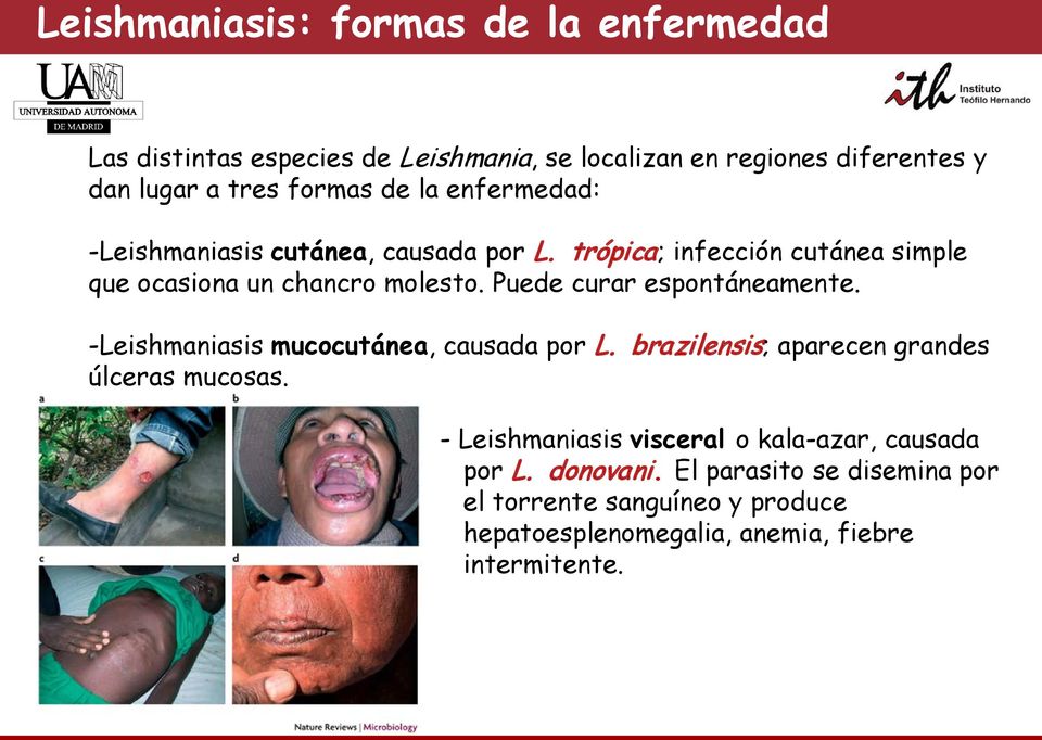 Puede curar espontáneamente. -Leishmaniasis mucocutánea, causada por L. brazilensis; aparecen grandes úlceras mucosas.