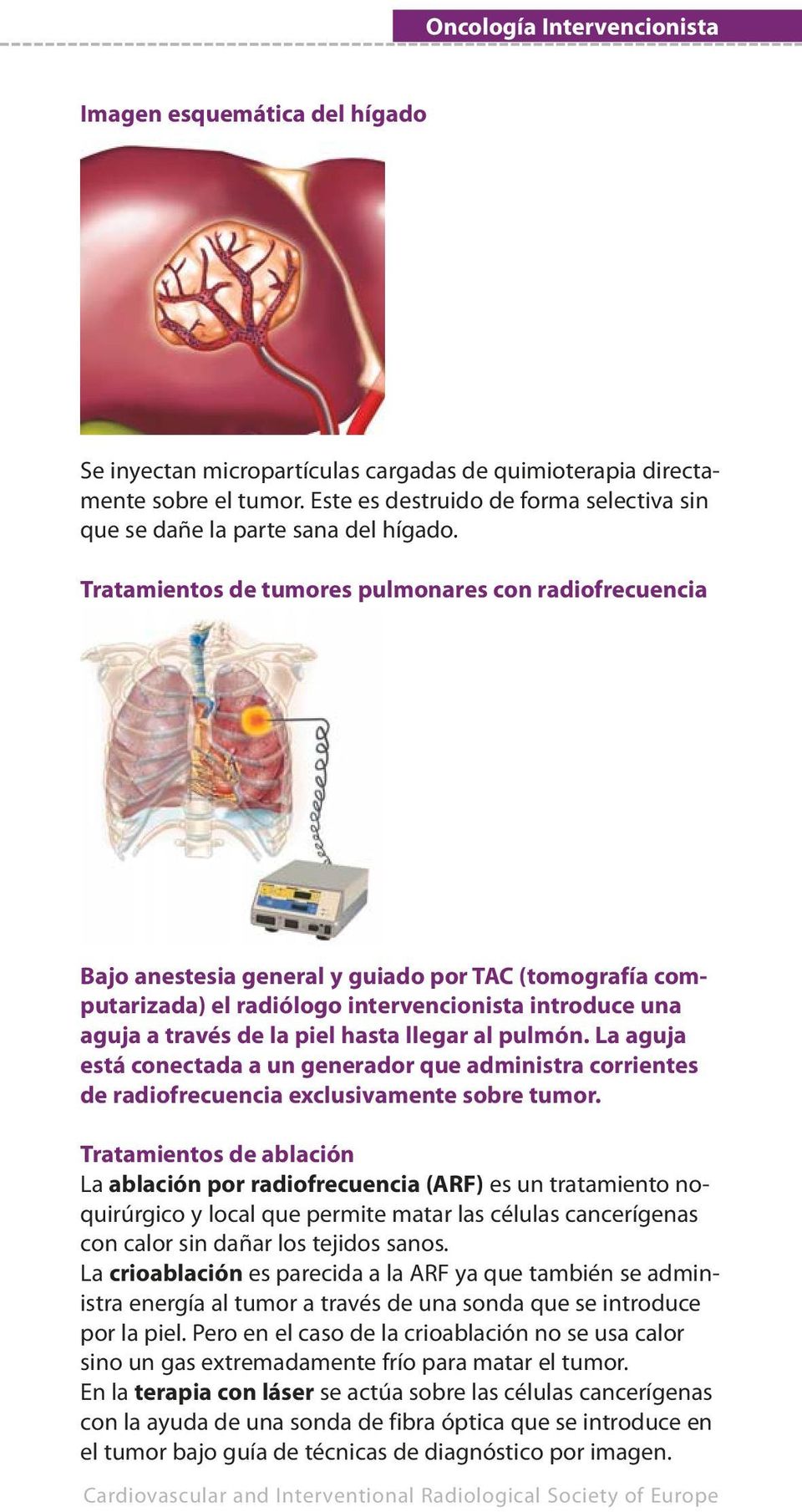 Tratamientos de tumores pulmonares con radiofrecuencia Bajo anestesia general y guiado por TAC (tomografía computarizada) el radiólogo intervencionista introduce una aguja a través de la piel hasta