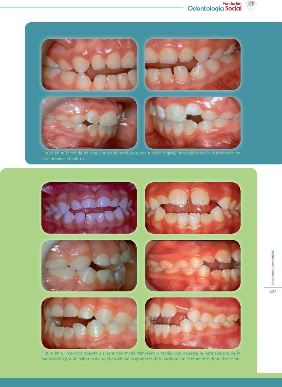 dentición mixta temprana y tardía que muestra la permanencia de la maloclusión por