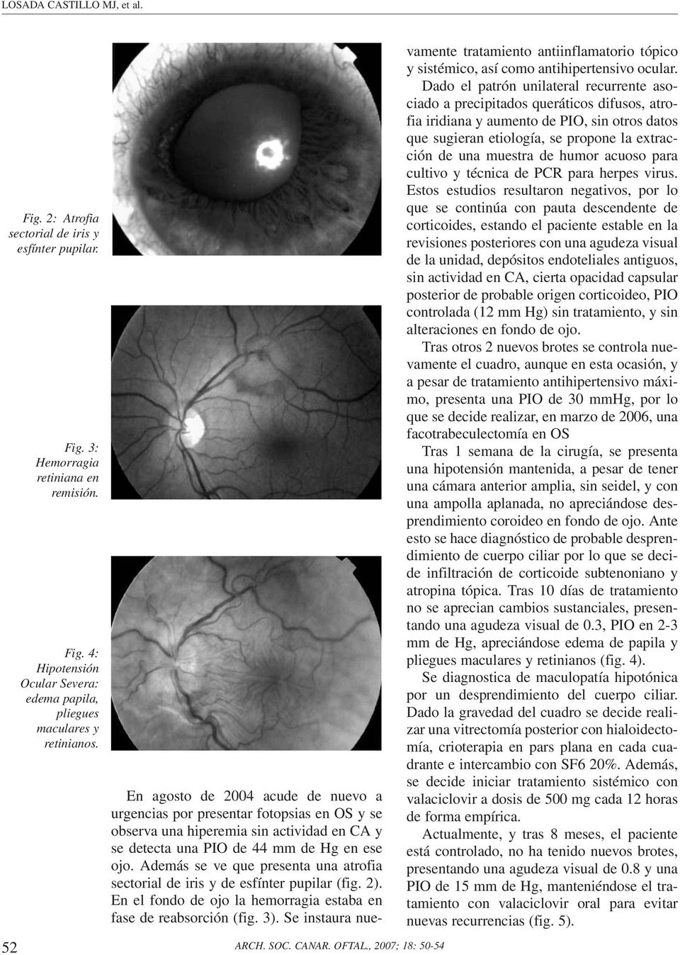 Además se ve que presenta una atrofia sectorial de iris y de esfínter pupilar (fig. 2). En el fondo de ojo la hemorragia estaba en fase de reabsorción (fig. 3).