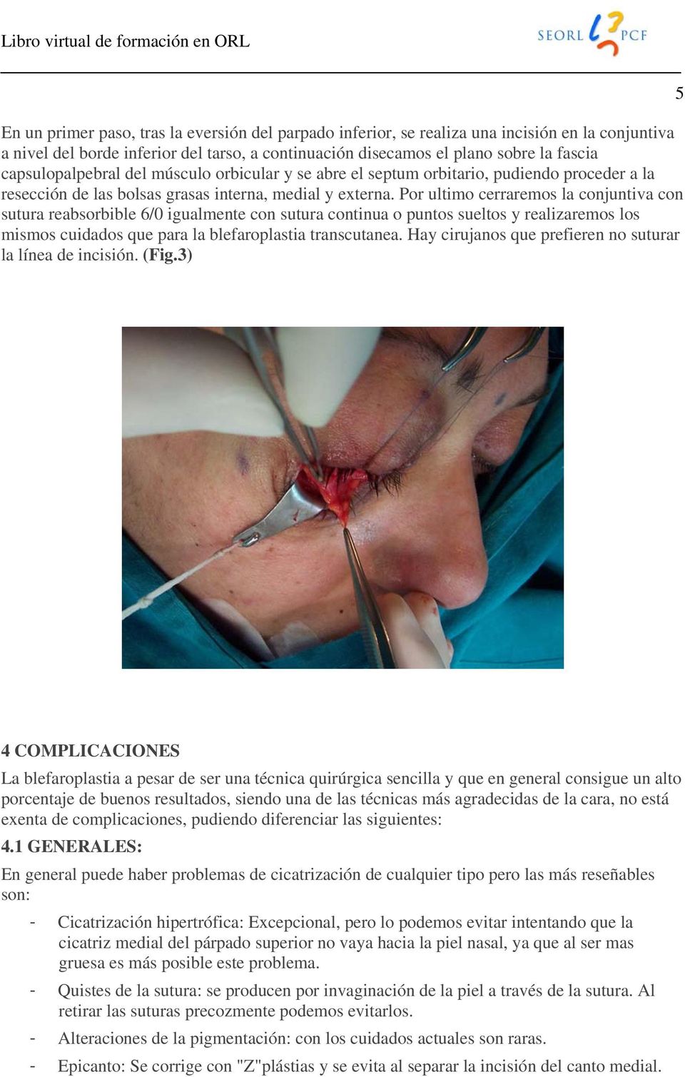 Por ultimo cerraremos la conjuntiva con sutura reabsorbible 6/0 igualmente con sutura continua o puntos sueltos y realizaremos los mismos cuidados que para la blefaroplastia transcutanea.