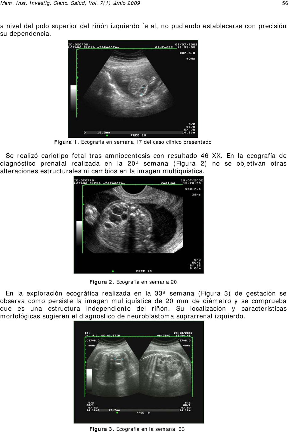 En la ecografía de diagnóstico prenatal realizada en la 20ª semana (Figura 2) no se objetivan otras alteraciones estructurales ni cambios en la imagen multiquística. Figura 2.