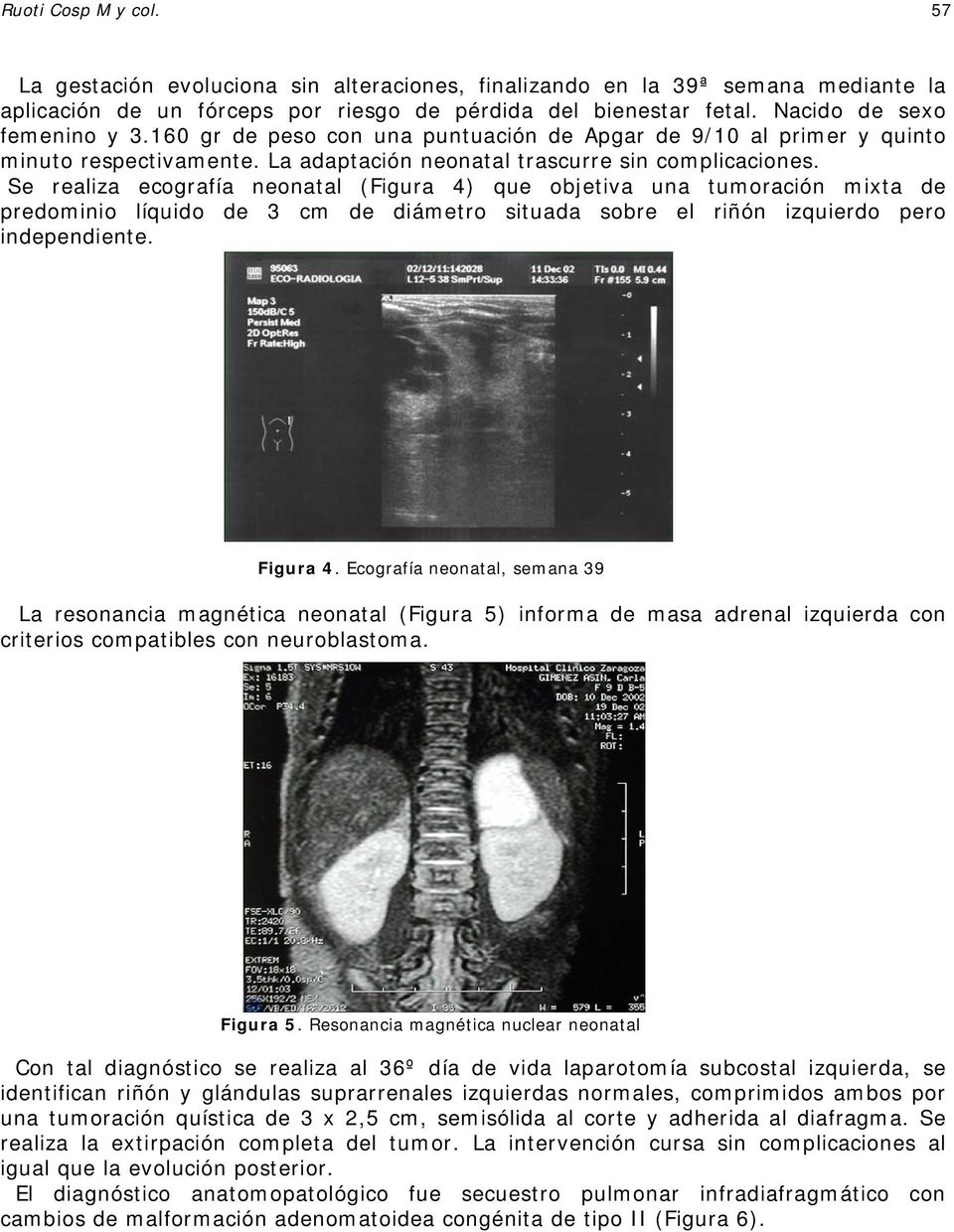 Se realiza ecografía neonatal (Figura 4) que objetiva una tumoración mixta de predominio líquido de 3 cm de diámetro situada sobre el riñón izquierdo pero independiente. Figura 4.