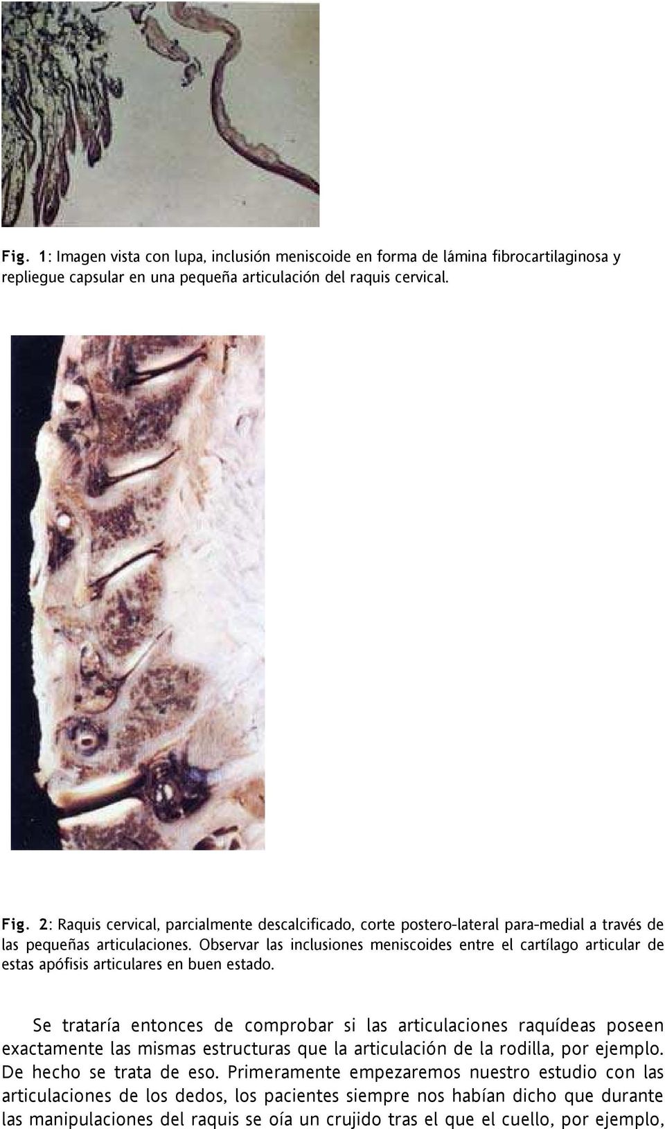 Observar las inclusiones meniscoides entre el cartílago articular de estas apófisis articulares en buen estado.
