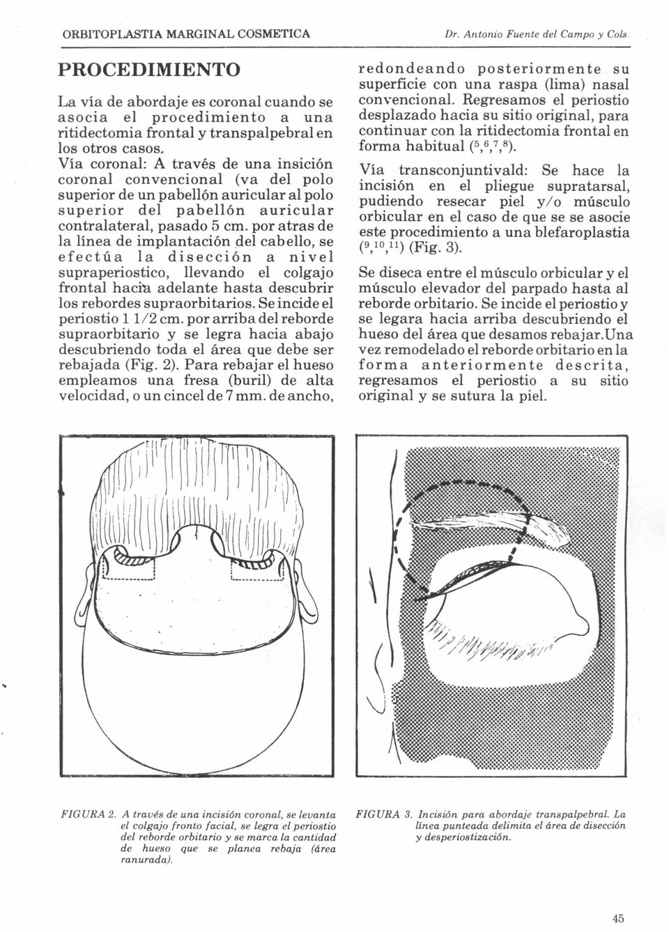 Vía coronal: A través de una insición coronal convencional (va del polo superior de un pabellón auricular al polo superior del pabellón auricular contralateral, pasado 5 cm.