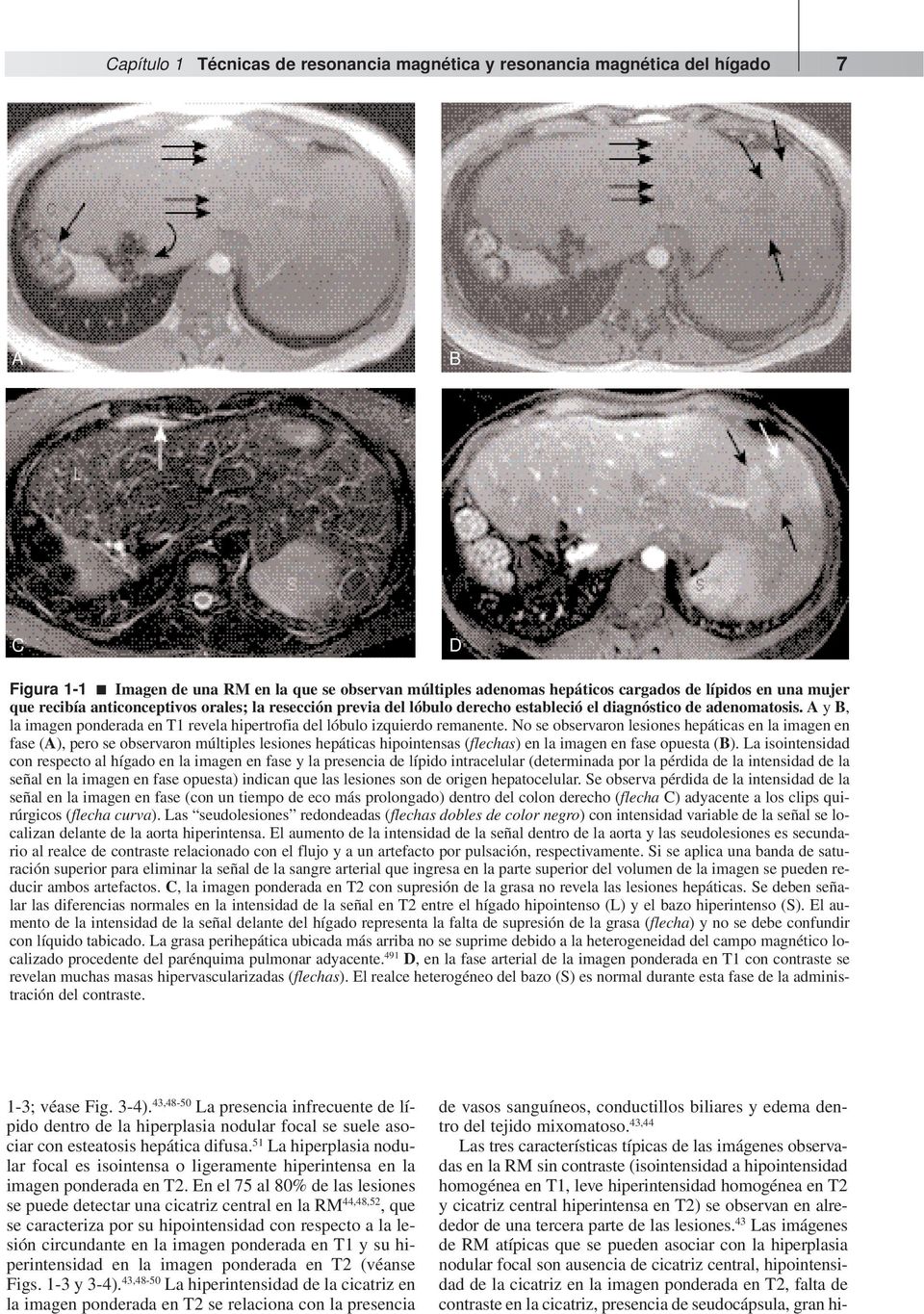 A y B, la imagen ponderada en T1 revela hipertrofia del lóbulo izquierdo remanente.