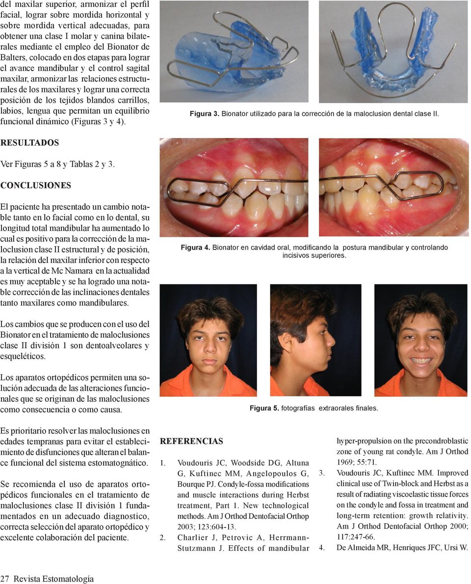 los tejidos blandos carrillos, labios, lengua que permitan un equilibrio funcional dinámico (Figuras 3 y 4). Figura 3. Bionator utilizado para la corrección de la maloclusion dental clase II.