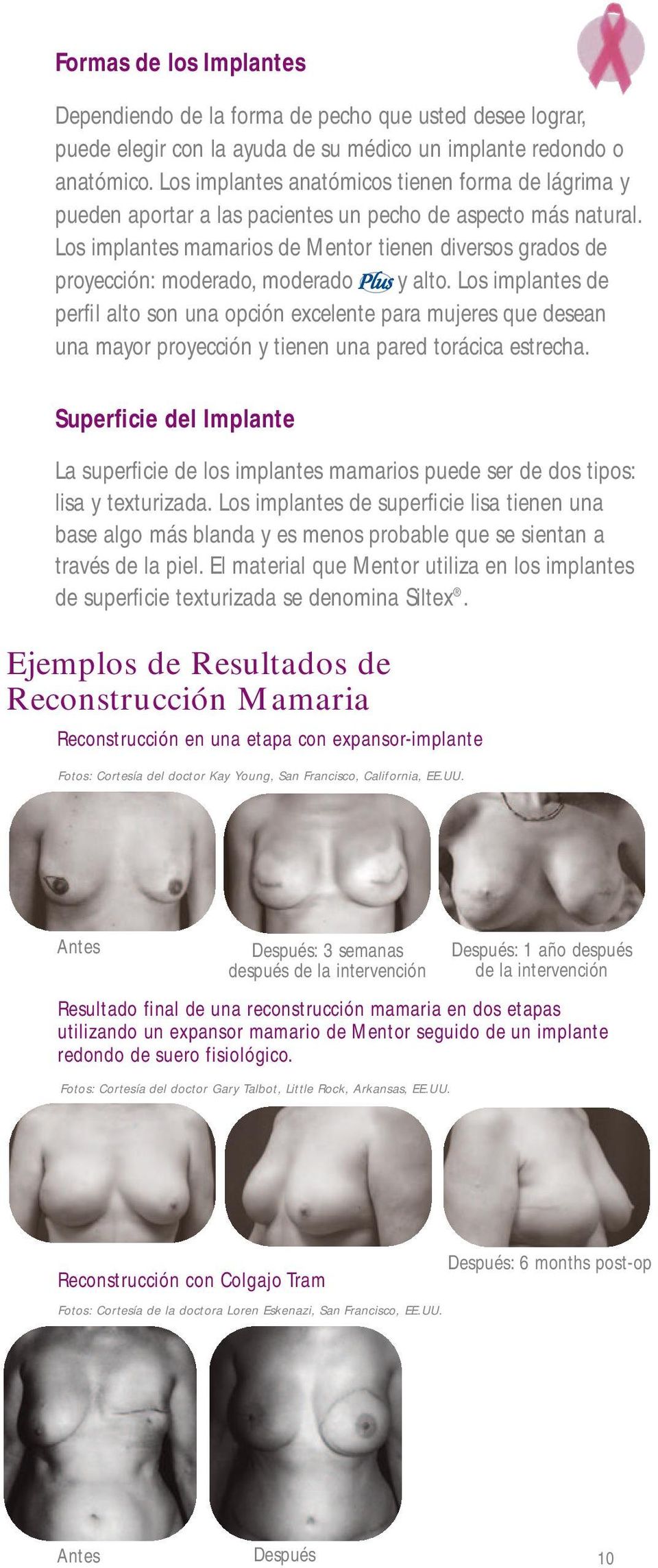 Los implantes mamarios de Mentor tienen diversos grados de proyección: moderado, moderado y alto.