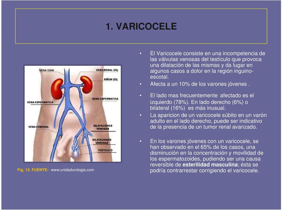 La aparicion de un varicocele súbito en un varón adulto en el lado derecho, puede ser indicativo de la presencia de un tumor renal avanzado. Fig. 12. FUENTE: www.unidadurologia.