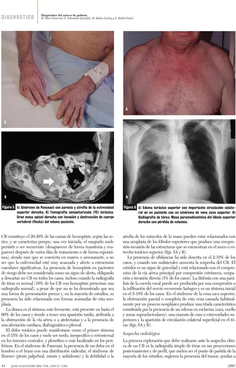 B Figura 6 A) Edema torácico superior con importante circulación colateral en un paciente con un síndrome de vena cava superior. B) Radiografía de tórax.