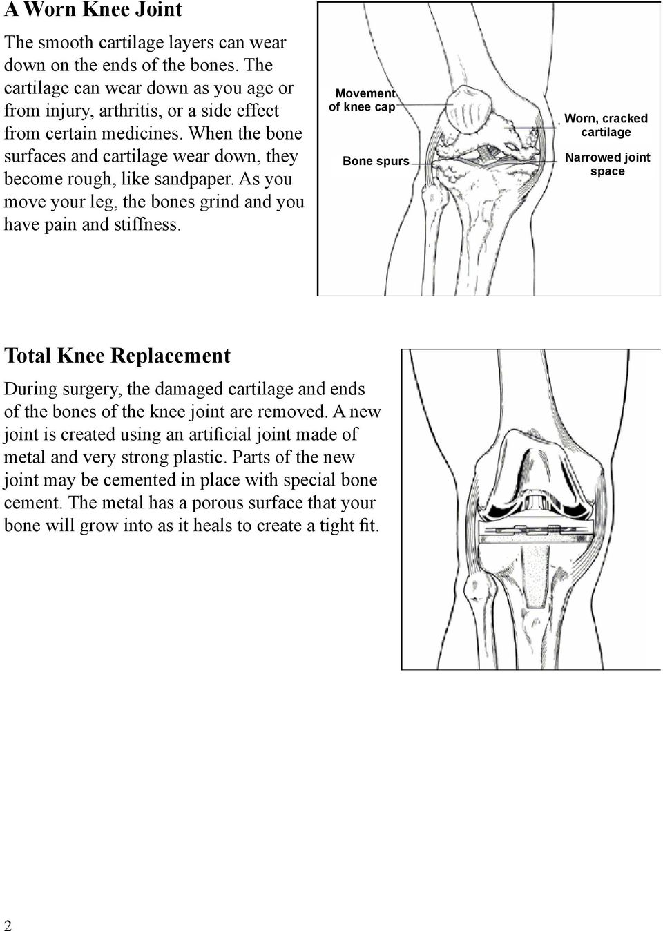 Movement of knee cap Bone spurs Worn, cracked cartilage Narrowed joint space Total Knee Replacement During surgery, the damaged cartilage and ends of the bones of the knee joint are removed.