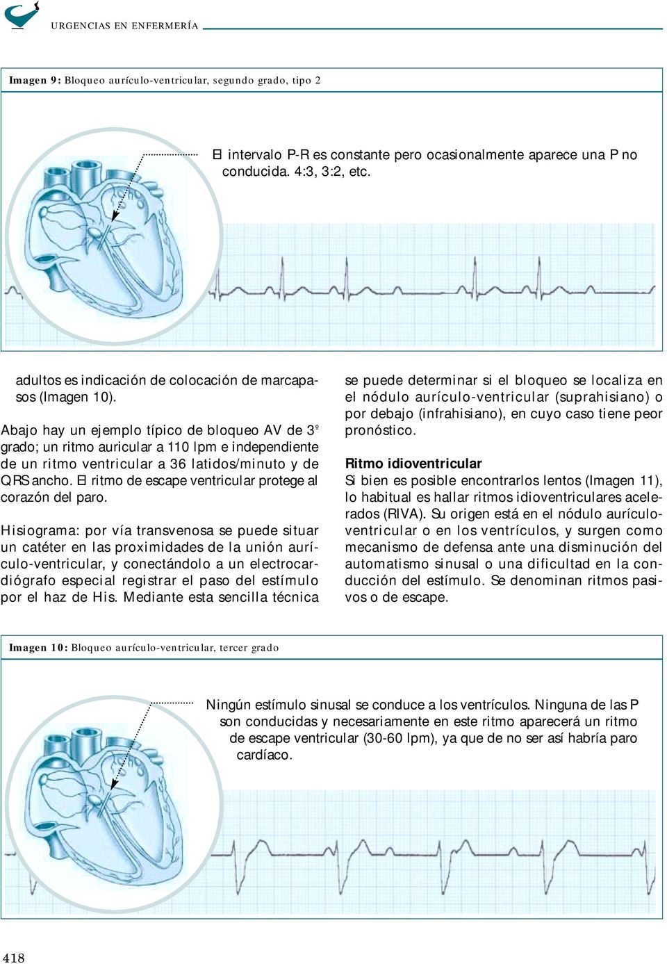 Abajo hay un ejemplo típico de bloqueo AV de 3 º grado; un ritmo auricular a 110 lpm e independiente de un ritmo ventricular a 36 latidos/minuto y de QRS ancho.