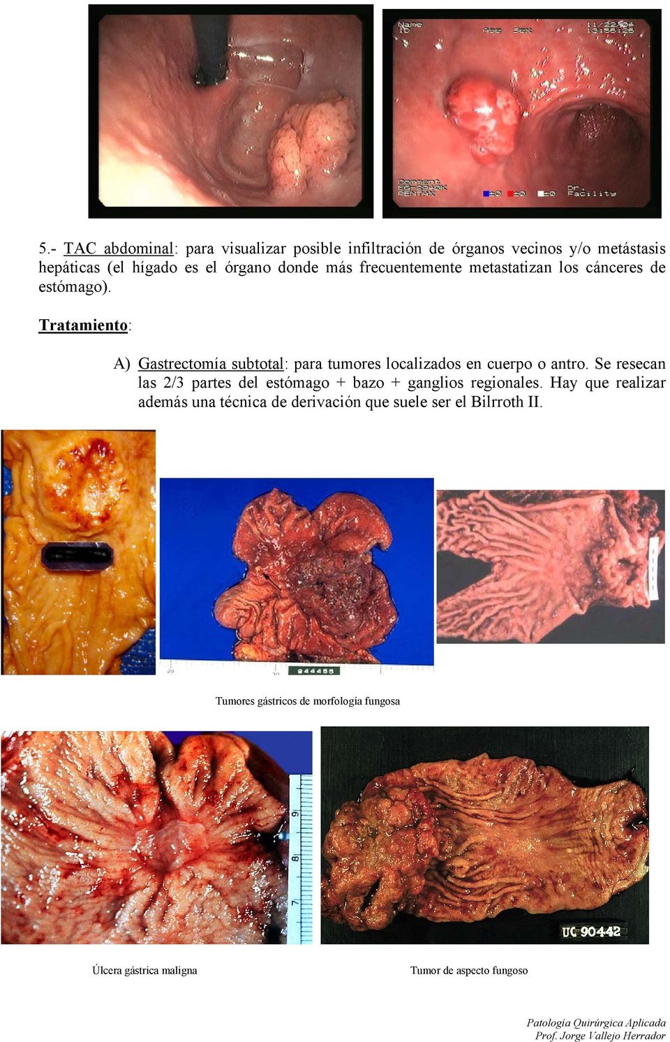 Tratamiento: A) Gastrectomía subtotal: para tumores localizados en cuerpo o antro.