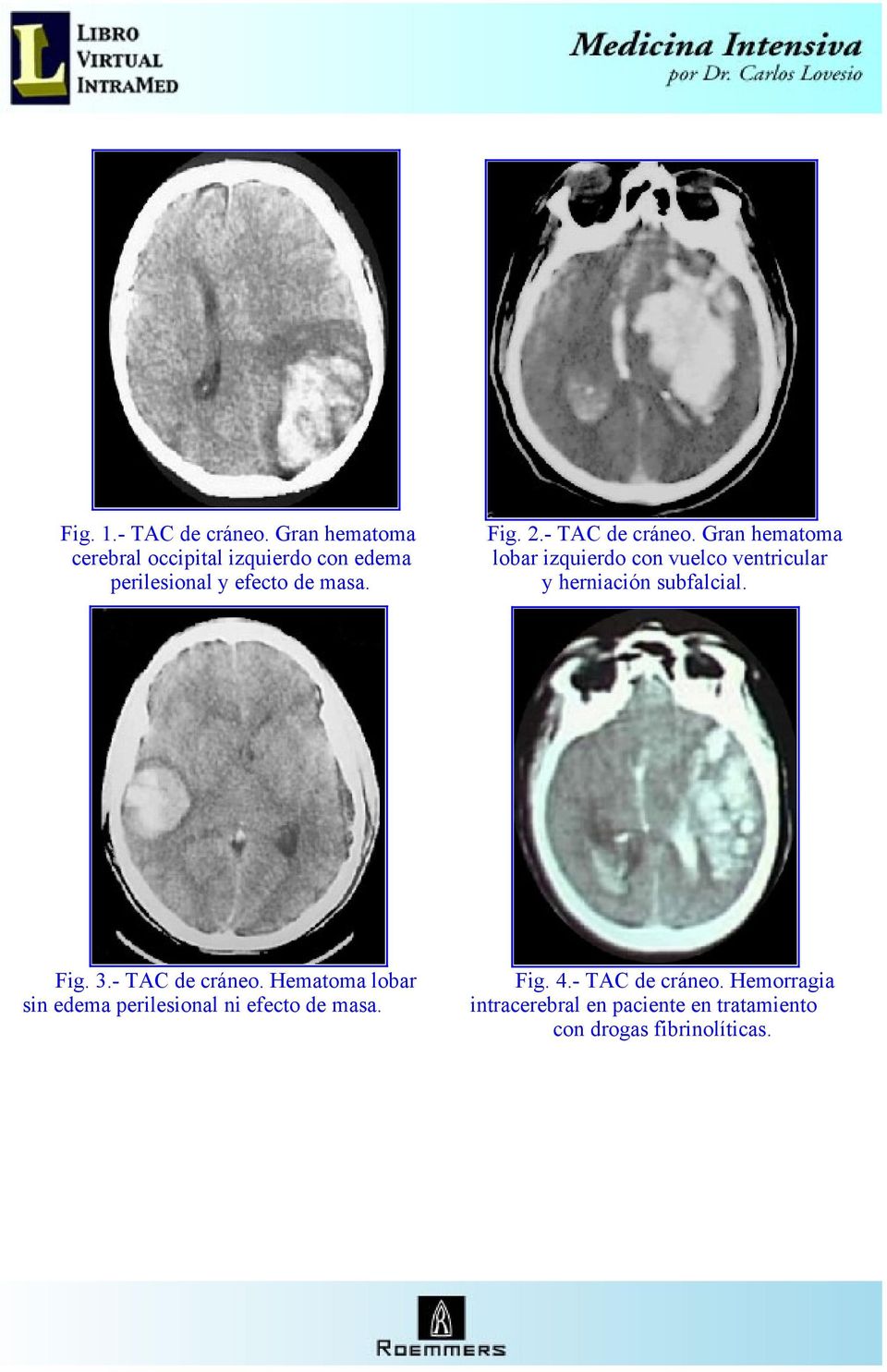 Gran hematoma cerebral occipital izquierdo con edema lobar izquierdo con vuelco ventricular