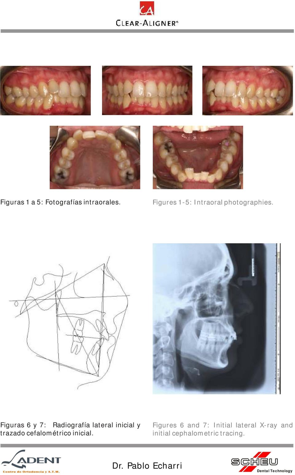Figuras 6 y 7: Radiografía lateral inicial y trazado